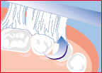 Teeth_cleaning_2.jpg